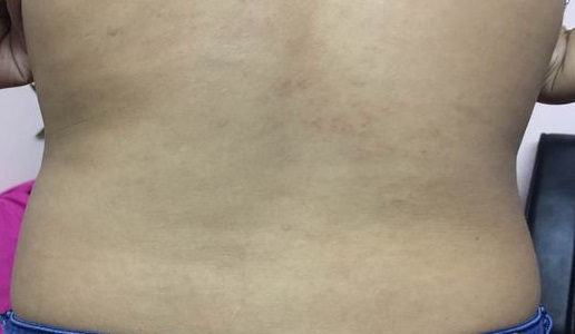 Bệnh chàm: Dấu hiệu nhận biết bị chàm da do giun sán